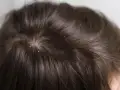 آیا استفاده از شامپوهای ضد شوره موثر است؟
