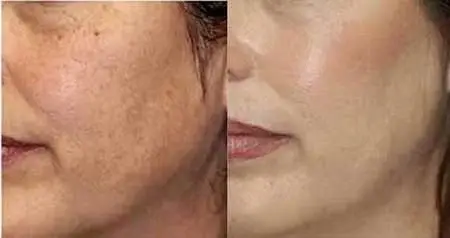 ترمیم طبیعی لکه های سیاه پوست