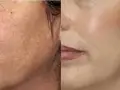 ترمیم طبیعی لکه های سیاه پوست