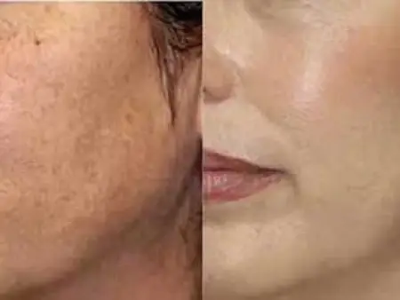 ترمیم طبیعی لکه های سیاه پوست