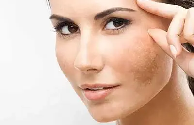 لکه صورت یا ملاسما را چطور درمان کنیم؟