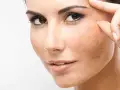 لکه صورت یا ملاسما را چطور درمان کنیم؟