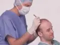 ضرورت مشاوره برای کاشت مو